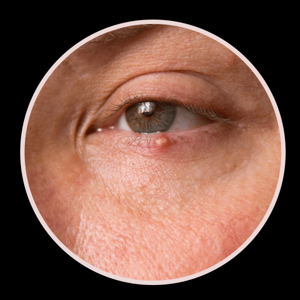 6 Types of Eyelid Bumps and How to Treat Them According to Dermatologists